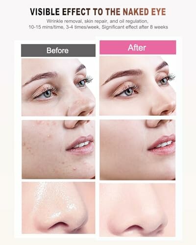 Before and after skin improvement comparison showing reduced blemishes and smoother skin.